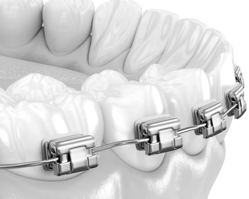 Self-litigating braces use a built in mechanism to hold the arch wire in place.